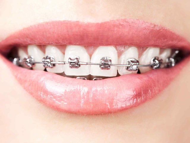 https://happyteethclinic.pk/wp-content/uploads/2020/01/post_05-640x480.jpg